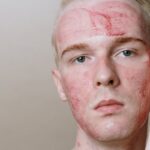 Beyond the Pimple: Real Solutions for Lasting Scar Clarity